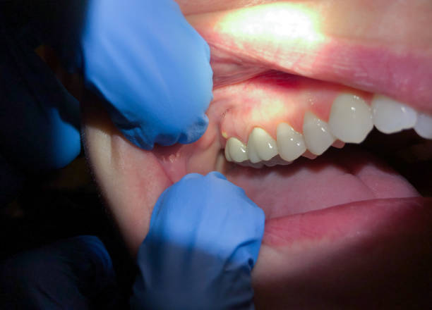Best Emergency Broken Tooth Repair in Grayling, MI